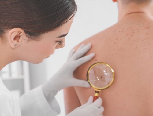 cancer-piel-detección