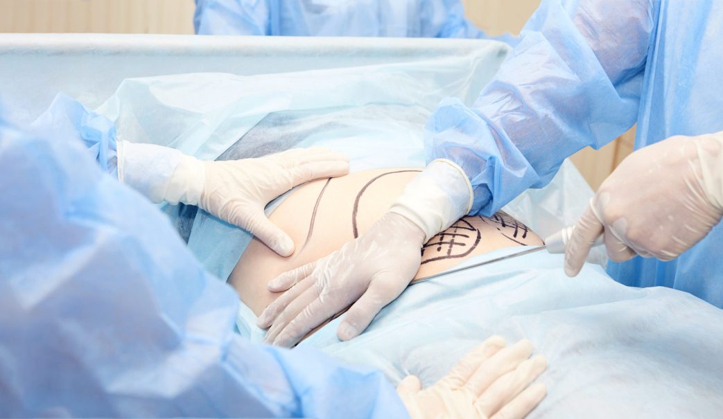 cirugia-pared-abdominal