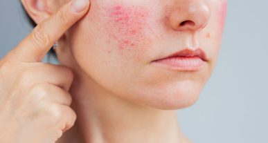 rosacea-enrojecimiento-cara