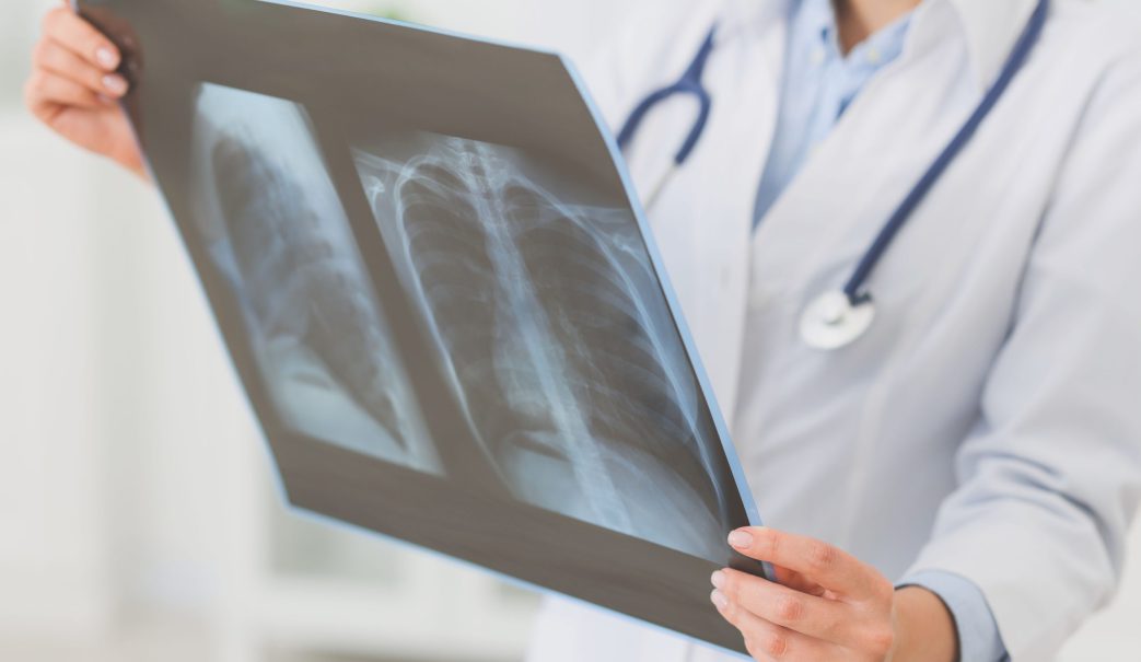 embolia-pulmonar-sintomas_BLOGHLA