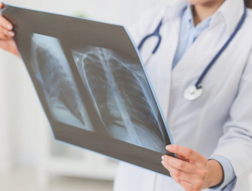 embolia-pulmonar-sintomas_BLOGHLA