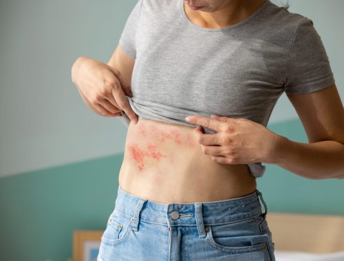 herpes-zoster-culebrilla