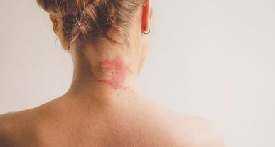 diez-tipos-dermatitis