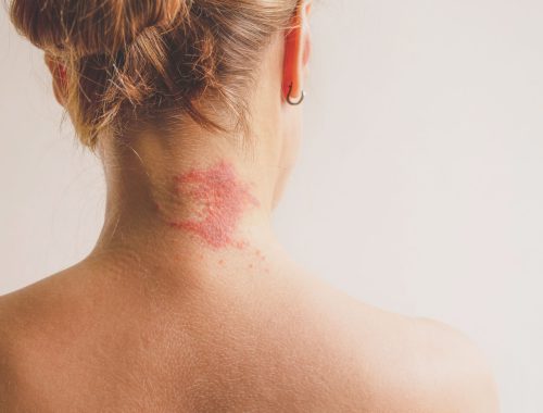 diez-tipos-dermatitis